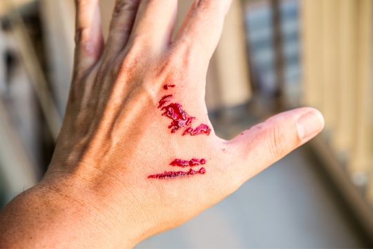 Personal Injury Bite (2)